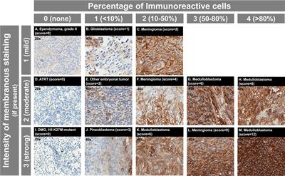 Immunohistochemical assessment and clinical, histopathologic, and molecular correlates of membranous somatostatin type-2A receptor expression in high-risk pediatric central nervous system tumors